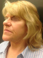 Facelift