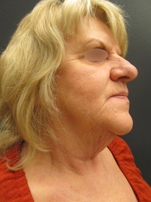 Facelift