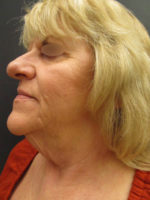 Facelift