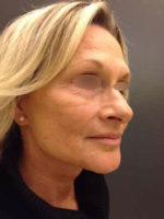 Facelift