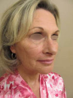 Facelift