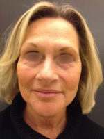 Facelift