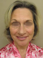 Facelift