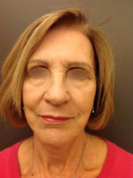 Facelift