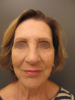 Facelift