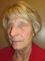 Facelift