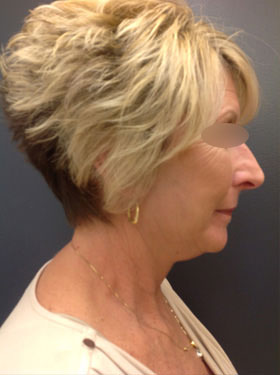 Facelift