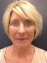 Facelift