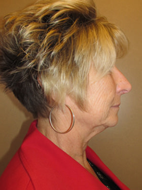 Facelift
