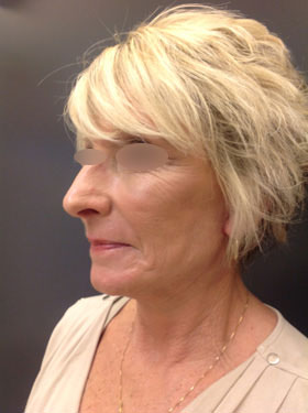 Facelift