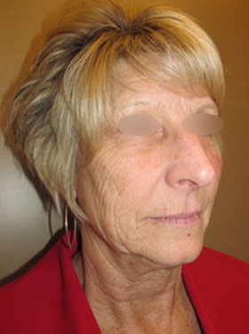 Facelift