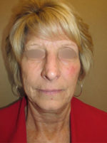 Facelift