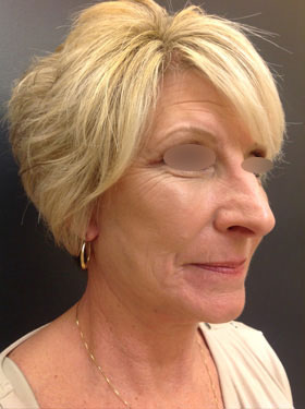 Facelift