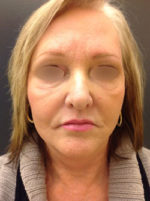 Facelift