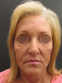 Facelift