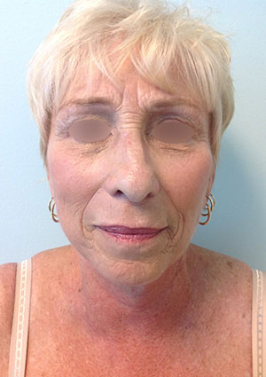 Facelift