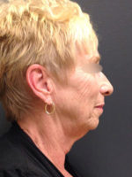 Facelift