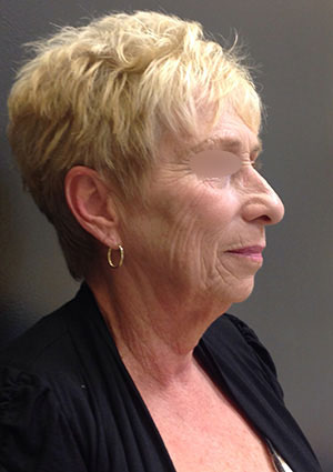 Facelift