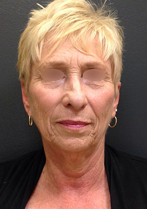 Facelift