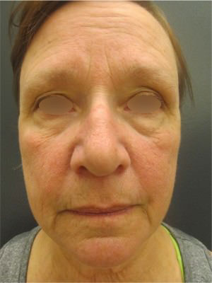 Facelift