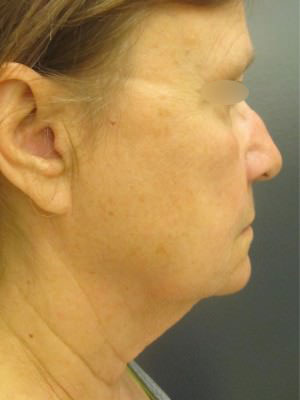Facelift