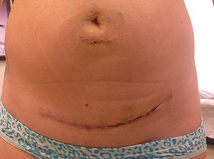 Scar Treatment