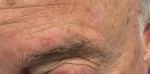 Actinic Keratoses