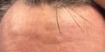 Actinic Keratoses