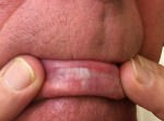 Actinic Keratoses