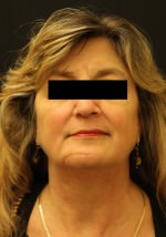 Juvederm