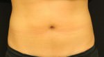 CoolSculpting