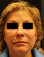 Juvederm