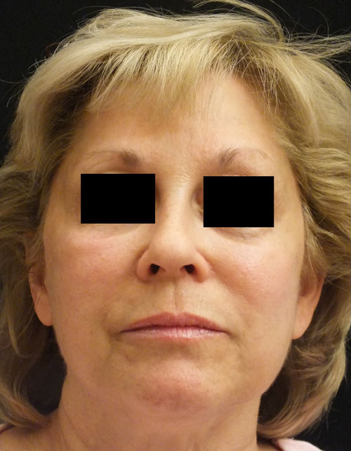 Juvederm