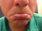Actinic Keratoses