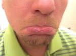Actinic Keratoses