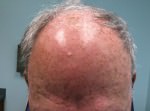 Actinic Keratoses