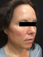 Juvederm
