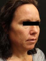 Juvederm