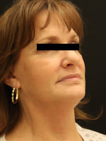 Facelift