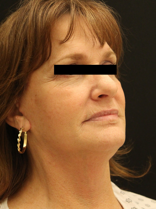 Facelift