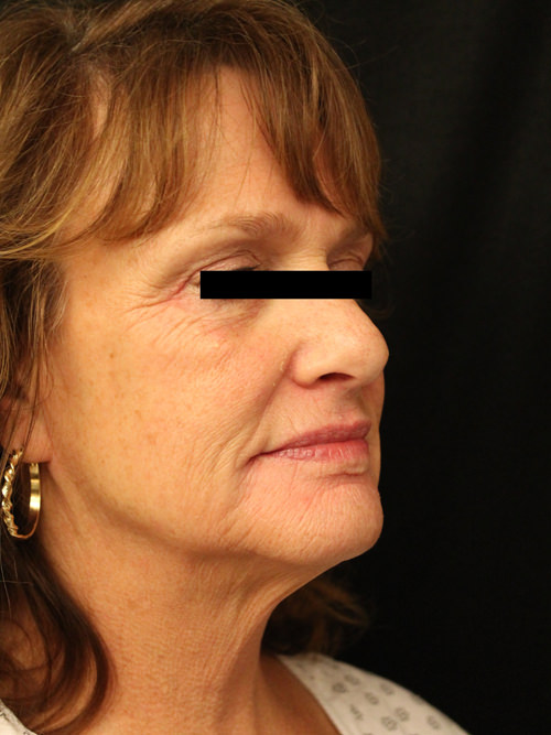 Facelift