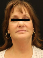Facelift