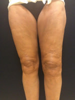 Thigh Lift