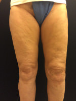 Thigh Lift