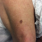 Dysplastic Nevus