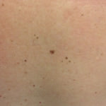 Dysplastic Nevus