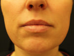 Juvederm