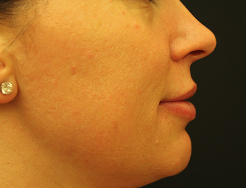 Juvederm