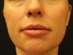 Juvederm