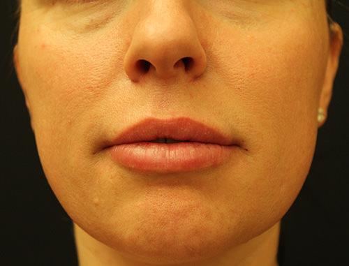 Juvederm